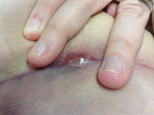 Left side of abdominal incision (blister)